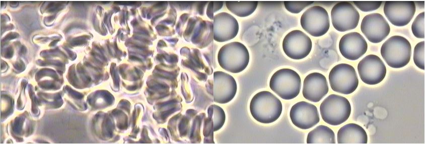 Before/after images of Creed’s red blood cells in response to specific dietary changes    June 11, 2011 & October 15, 2011